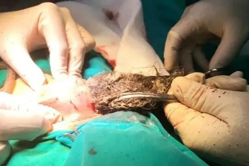 Bác sĩ phẫu thuật lấy búi tóc dài gần 20cm ra khỏi dạ dày bệnh nhi. Ảnh: Bệnh viện Nhi Thanh Hóa/Dân trí