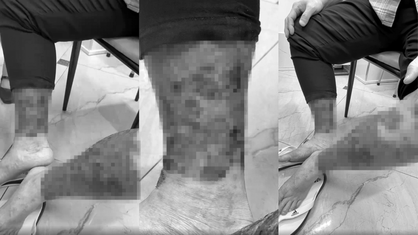 Ngứa kéo dài khiến hai cẳng chân phù nề, rỉ dịch, đóng vảy, xuất hiện nhiều mụn mủ do bội nhiễm. Ảnh: BSCC