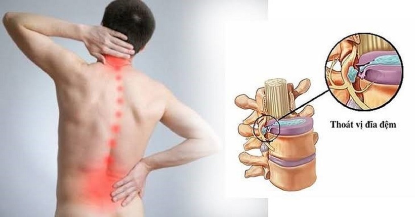 Tỷ lệ người trẻ mắc thoát vị đĩa đệm đang gia tăng rõ rệt