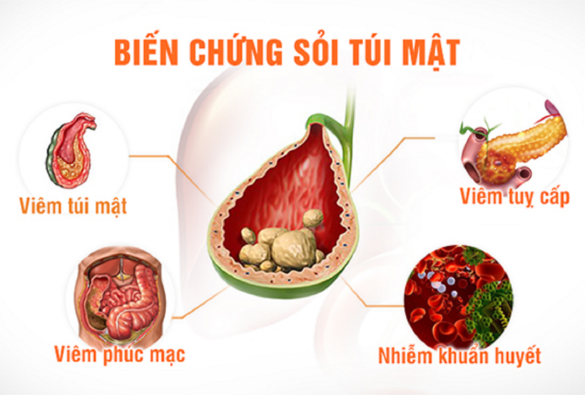 Các biến chứng thường gặp của sỏi mật