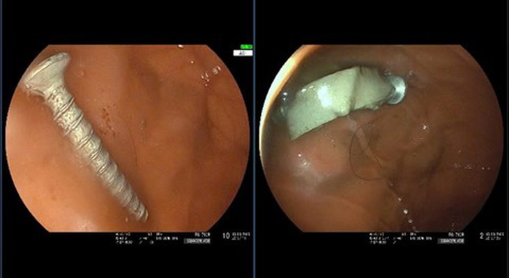 Hình ảnh các dị vật trong đó có đinh vít dài 4cm mà trẻ đã nuốt vào dạ dày. Ảnh: Tuổi trẻ Online