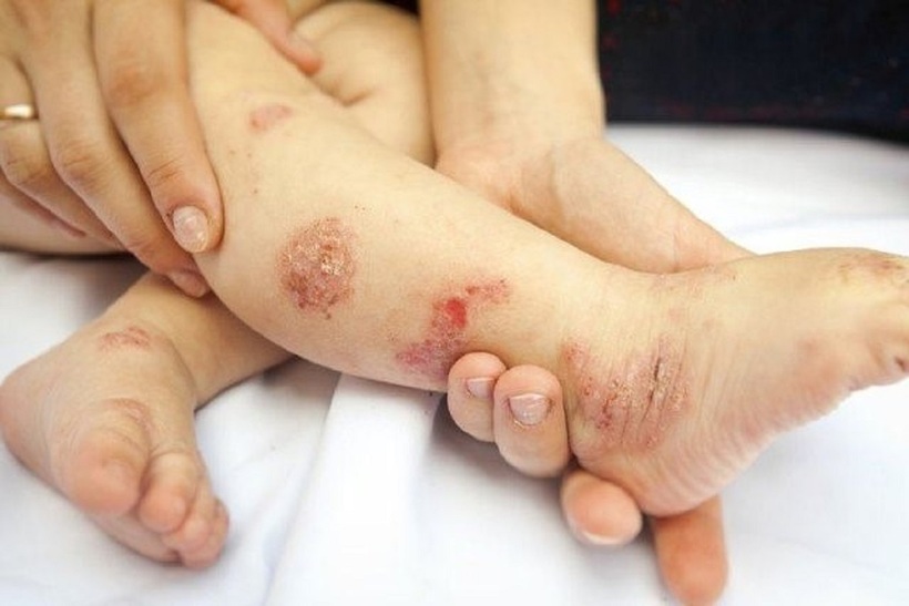 Viêm da là tình trạng thường gặp ở trẻ nhỏ