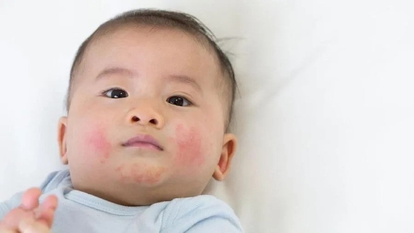 Mặc quần áo quá dày và bí khiến có thể làm khởi phát viêm da ở trẻ