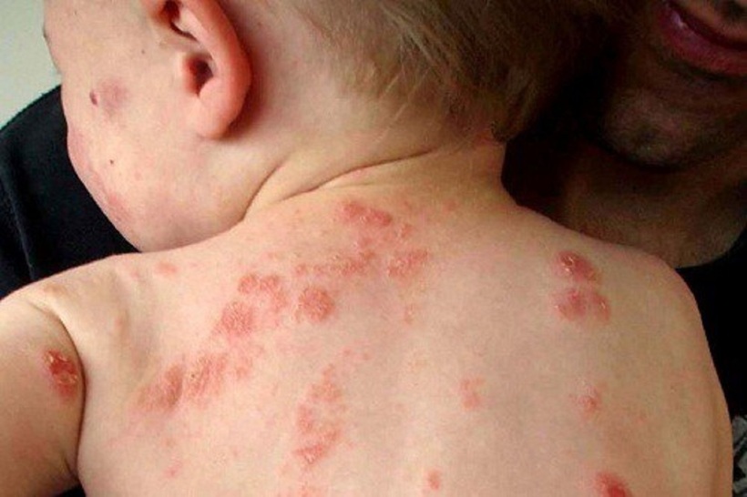 Viêm da khiến da bé ngứa ngáy khó chịu
