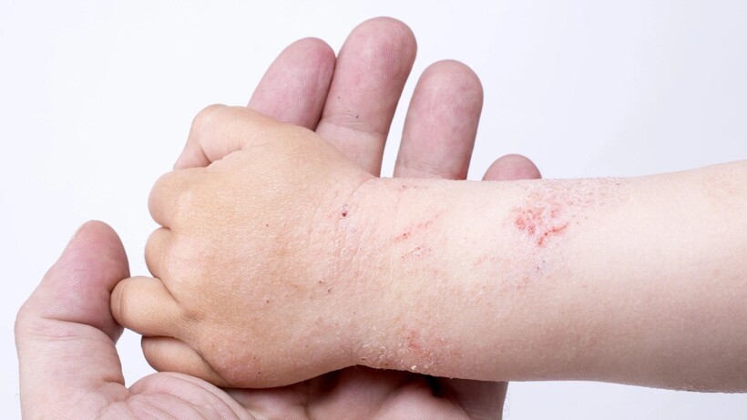 Chăm sóc viêm da cần hướng đến việc duy trì độ ẩm tự nhiên cho da