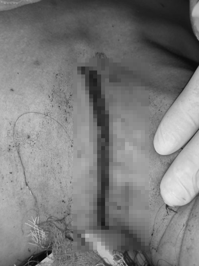 Vị trí dây chuyền tiếp xúc với da gây bỏng vùng cổ cho người bệnh sau khi bị sét đánh