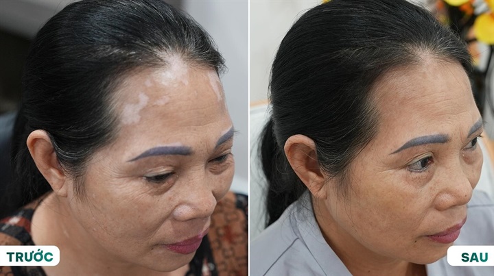 Kết quả điều trị bạch biến ghi nhận sự cải thiện sắc tố da rõ rệt nhờ công nghệ Excimer E-VN. Nguồn ảnh St. Paul cung cấp