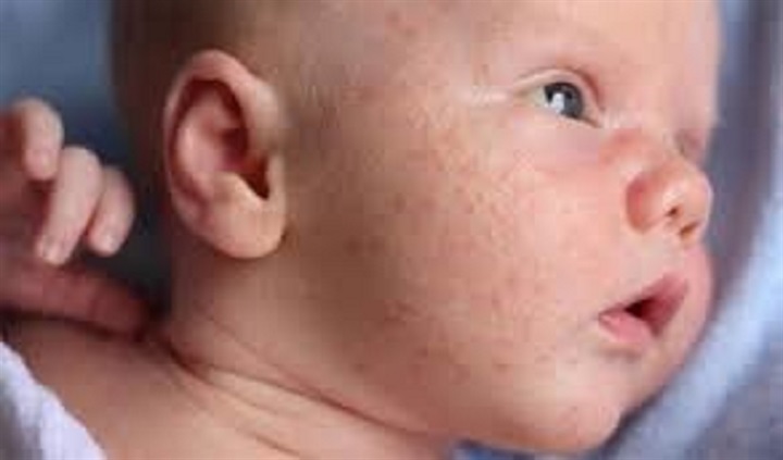 Cha mẹ cần giữ da bé thông thoáng và sạch sẽ để hạn chế rôm sảy