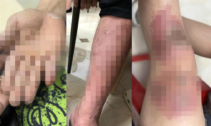 Lội nước ngập nhiều giờ, cảnh giác với những dấu hiệu bất thường trên da. Ảnh: BSCC