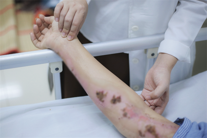 Bệnh nhân bị sét đánh được điều trị tích cực, hiện đã qua cơn nguy hiểm. Ảnh: Dân trí