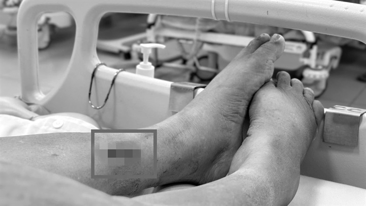 Mảnh tre 3cm nằm sâu trong chân, người phụ nữ 67 tuổi hai lần nguy kịch vì uốn ván. Ảnh: BVCC
