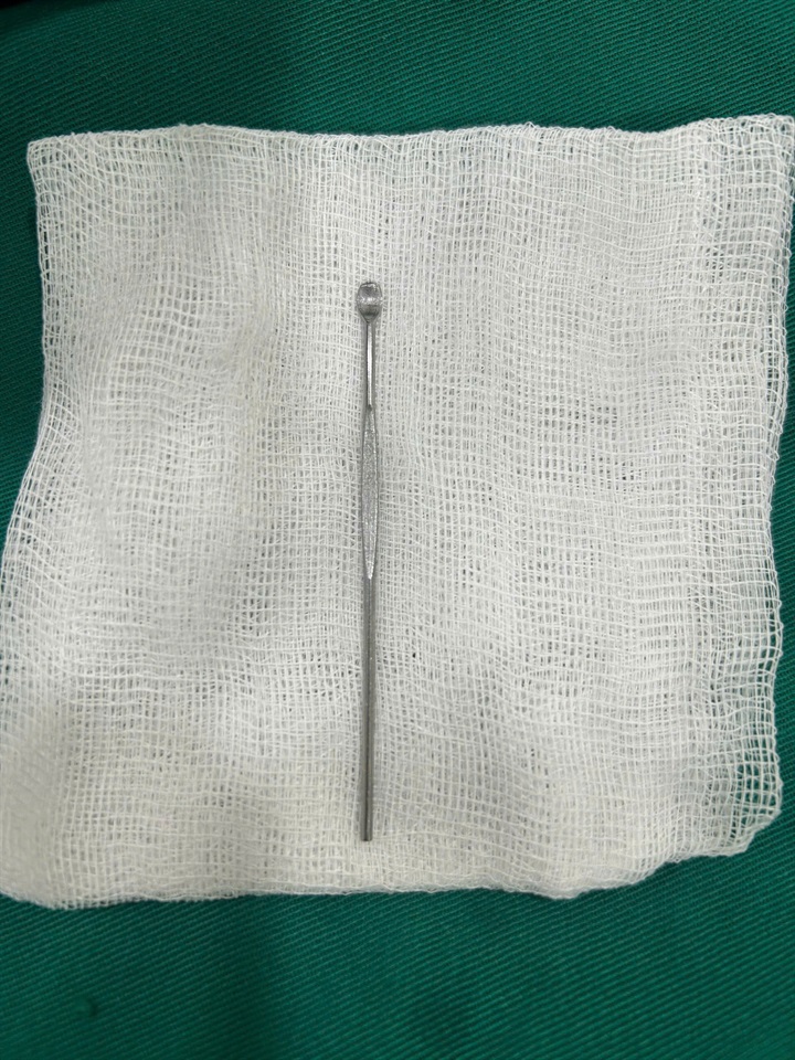 Dị vật dài 12cm trong niệu đạo bé trai 14 tuổi. Ảnh: BVCC