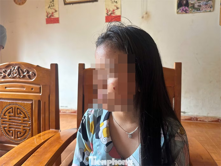 Khuôn mặt em T. có vết thương được cho là do bị điếu thuốc châm. Ảnh: Tiền phong