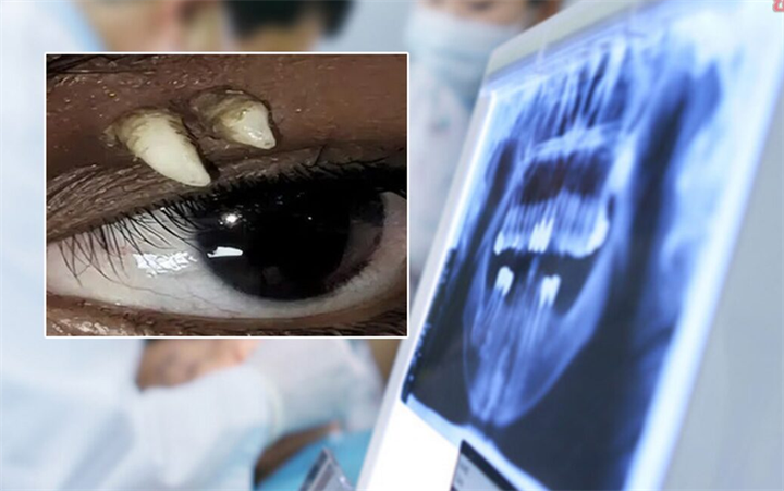 Răng hoàn chỉnh mọc trong hốc mắt bệnh nhân 16 tuổi ở Ấn Độ. Ảnh: AAO Journal