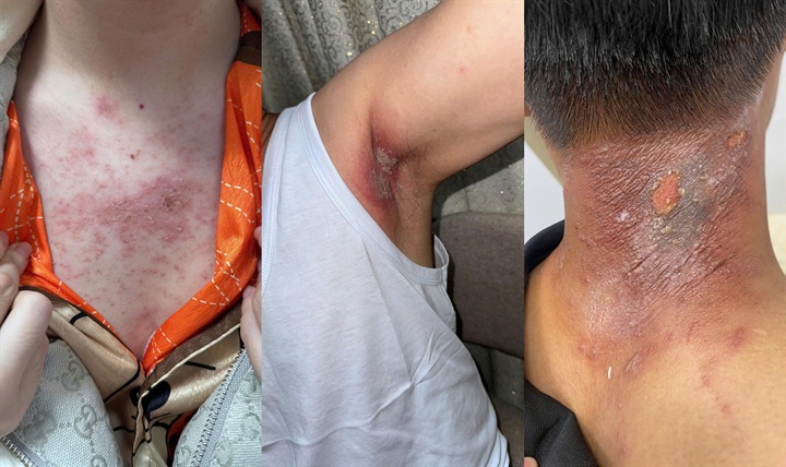 Vệt đỏ bỏng rát xuất hiện sau một đêm, người phụ nữ đi khám phát hiện viêm da do kiến ba khoang. Ảnh: BSCC