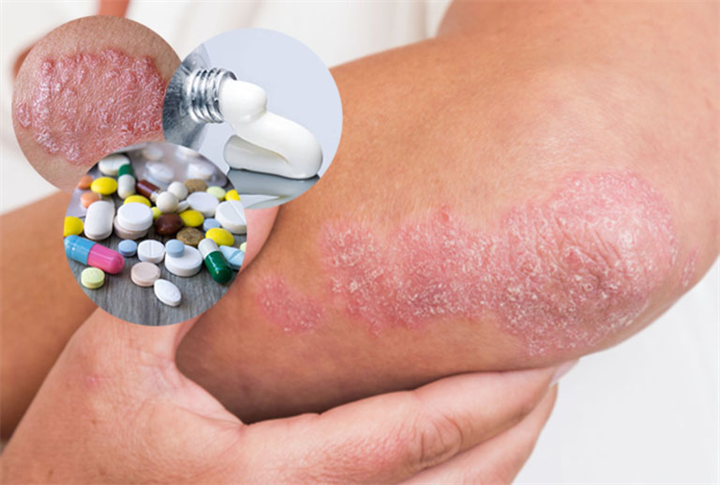 Thuốc Tây giúp kiểm soát triệu chứng nhưng có tác dụng phụ khi dùng lâu dài