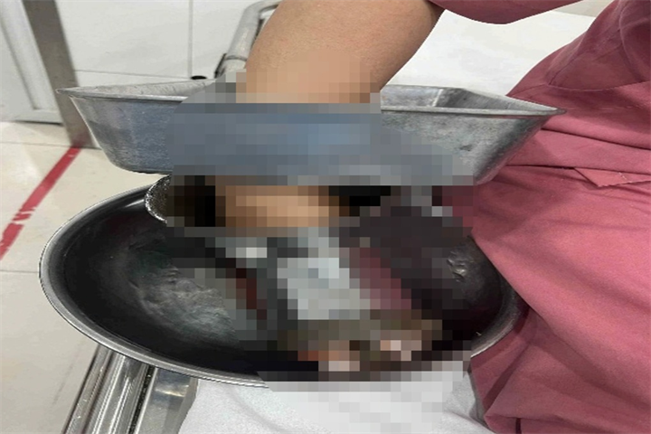 Bàn tay người bệnh vẫn mắc kẹt trong máy xay thịt khi được đưa đến bệnh viện cấp cứu. Ảnh: Dân trí